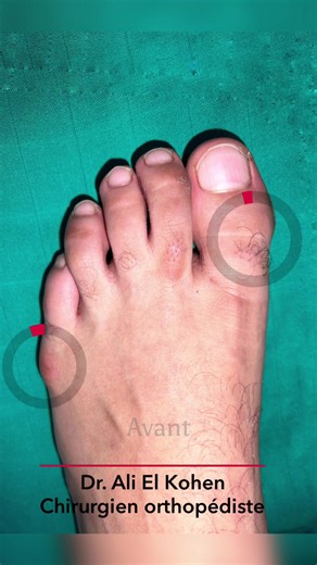 Tailor’s bunion, also called a bunionette, is a prominence of the fifth metatarsal bone at the base of the little toe. The metatarsals are the five long bones of the foot. The prominence that characterizes a tailor’s bunion occurs at the metatarsal head, located at the far end of the bone where it meets the toe. • • • #tailorsbunion #bunionette #orthopaedic #footsurgery #fyp #pourtoi #health #foryou #orthopaedicsurgeons #hospital #surgeon #dralielkohen