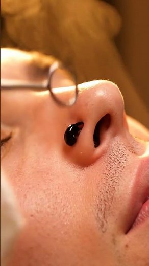 “The Most Satisfying Full-Body Blackhead Extraction Ever”