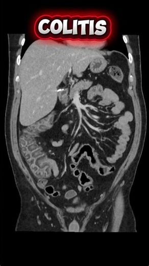 Colitis | CECT Abdomen #colitis #cectabdomen #aiims #inflamation #doctor #shorts #crohnscolitis