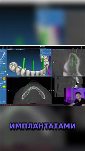 Как измерить углы между имплантатами 🦷