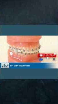 How to wear Class-II-Elastics