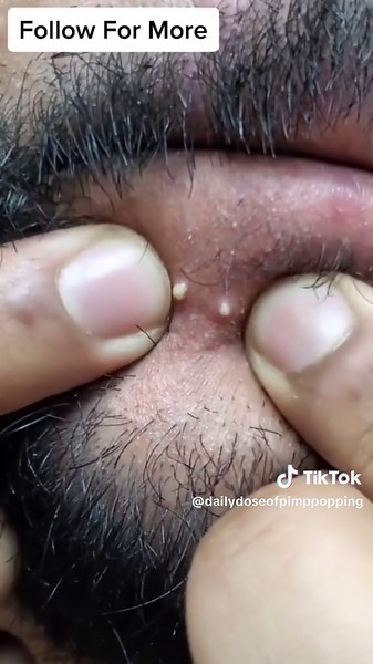 Jellyed Finger #pimples #satisfying #pop