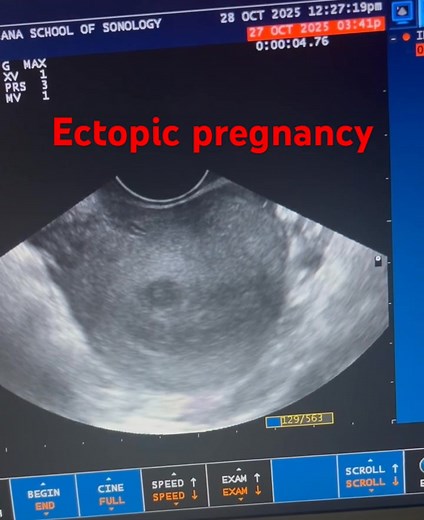 A complex heterogeneous mass is seen in the left adnexal region, separate from the left ovary, showing a gestational sac–like structure with a possible yolk sac/fetal pole within. No intrauterine gestational sac is identified. There is increased peripheral vascularity (“ring of fire” appearance) on color Doppler. Mild to moderate free fluid is noted in the pelvis, suggestive of possible hemoperitoneum #EctopicPregnancy #AdnexalMass #LeftAdnexa #UltrasoundFindings #RingOfFire #OBGYN #Sonography #
