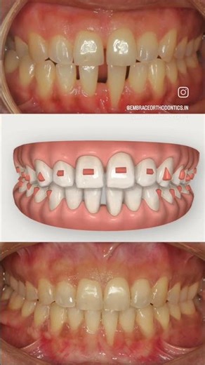 Gap closure + Crossbite correction with Invisalign for a 35 Yr Female. #invisalign