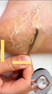 ✅Get Rid Of Cracked Heels/Heels Repair Home Remedies #shorts #crackedheels #heels #feetcare #crackedrepair #viralreelsシ #fbreelsfypシ゚ | Back to nature remedy