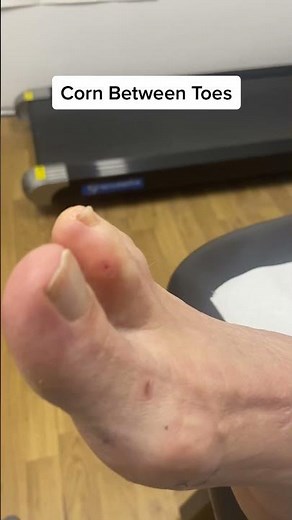 Explore corn removal journey! Relieve your feet from the pain! 👣👍 #CornRemoval #FootCare