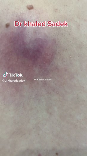 Infected back cyst #cystremoval #drkhaledsadek #SkinCare