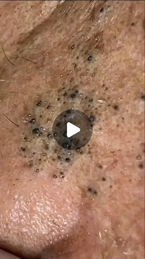Pimple Content⚠️ on Instagram: "Comment your reaction 🍿 - #pimples #pimplespopper #pimplevideos #blackheadremoval"