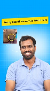 Dealing with beard loss, patchy beard, or thinning facial hair? You’re not alone. Nagendra shares his real journey of beard regrowth with VCare Clinic’s advanced Microneedling treatment. ✅ Visible beard growth results in just 2 sessions ✅ Complete transformation with 6 sessions ✅ Natural, fuller, and healthier beard regrowth ✅ Personalized treatment plan by certified doctors At VCare Clinic, we specialize in advanced hair & skin solutions that restore confidence and deliver proven results. 📞 Ca