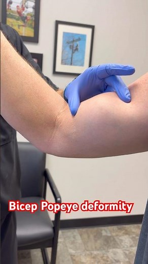 What’s a Bicep Popeye deformity? #medstudent #physician #doctorsoftiktok #bicep #sportsmedicine