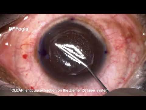 CLEAR lenticule extraction refractive surgery on Ziemer Z8
