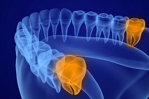 Why Do Wisdom Teeth Come In So Late? | The Dental District