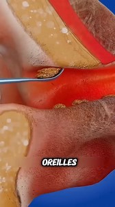 Astuces pour enlever le cérumen naturellement 👂✨ Le cérumen protège l’oreille, mais son excès peut causer des gênes auditives. Pour l’éliminer en douceur, il existe des méthodes naturelles et efficaces qui permettent de ramollir et d’évacuer les bouchons sans agresser le conduit auditif. Une bonne hygiène régulière aide à prévenir l’accumulation. En cas de gêne persistante, il est préférable de consulter un professionnel. ✅👩‍⚕️ #Hygiène 👂 #SantéAuditive 🎧 #OreillesPropres 🧼 #SoinNaturel 🍃 