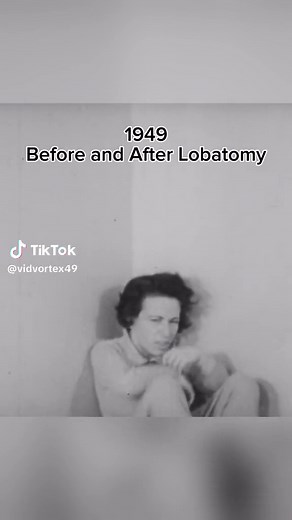 20,000 lobatomies were done between 1949 and 1951, what do you think of this? #lobatomy #creepy #scary #fyp #surgerytiktok