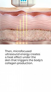 Did you know? Ultherapy PRIME is the only FDA-cleared non-invasive...