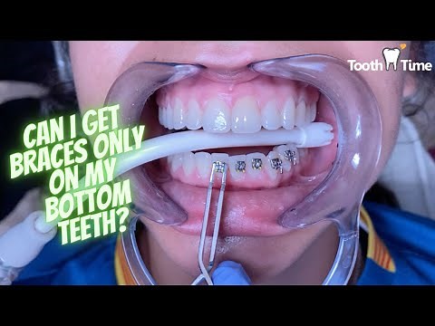 Can I only get braces on my bottom teeth? - Braces On - Tooth Time Family Dentistry New Braunfels TX