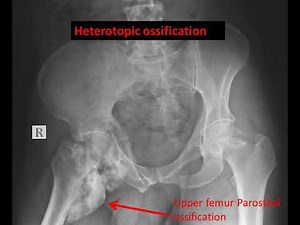 case 572 heterotopic ossification HO