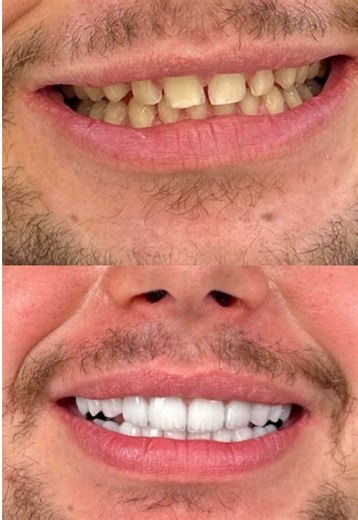Do you want a perfect smile without having to file your teeth? No prep veneers and porcelain veheers dubai provide natural and radiant Hollywood smile Dubai. Our dental clinic Dubai offers high-end veneers in Dubai for long-lasting and beautiful results. Contact our team to learn more 📩. #DentalVeneersDubai #HollywoodSmileDubai #clinicaldubai #NaturalVeneers #dentaltourismdubai