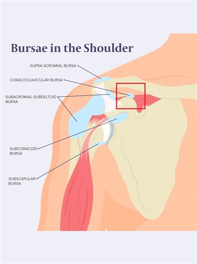 The coracoclavicular bursa is an anatomic bursa located between the coracoid process of the scapula and the clavicle, closely associated with the conoid and trapezoid components of the coracoclavicular ligament. Its function is to reduce friction and facilitate smooth motion between the clavicle and coracoid during shoulder elevation and scapular rotation. Pathology of this bursa, though uncommon, can include inflammation or bursitis, which may contribute to anterior shoulder pain and mimic acro