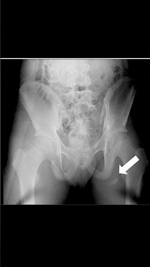 Ischial Tuberosity Avulsion Fracture #xray #radiology #orthopedics #meded