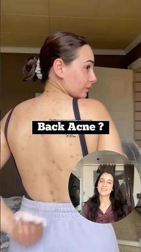 3 step routine to get rid of back acne #skincare #shorts