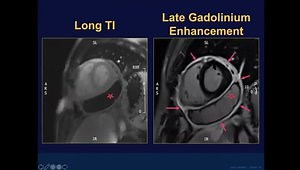 Pericardial Disease: Current Multi-Modality Approach