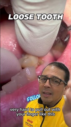 Why You NEED to Go to the Dentist to Extract a Broken Tooth | In Office to Hands On Dental Training