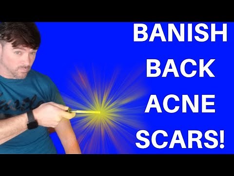 How To Get Rid Of Acne Scars On Your Back ( and everywhere else)