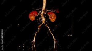 CTA abdominal aorta 3D rendering image of the arteries in the whole body generate from CT scanner.