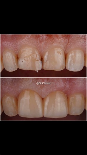 MINIMALLY INVASIVE VENEERS #LASVEGASCOSMETICDENTIST #AKULTIMATEDENTALPC #DRALEXANDRUCHIREU