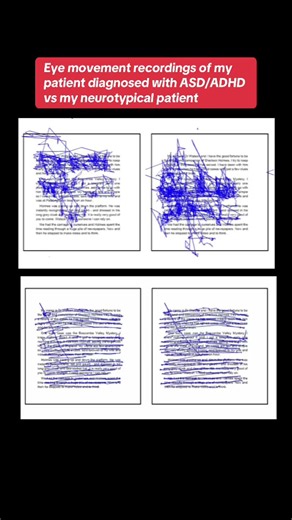 Eye movement recordings comparing a patient diagnosed with ADHD/ASD and a neurotypical patient
