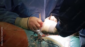 Cardiovascular surgery doctor in surgery center for interventions with instruments in surgeon operation electrosurgery with thoracotomy microsurgery doing minimal invasive open heart surgery