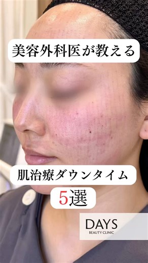 5 skin treatment downtime tips from a cosmetic surgeon!! #shorts