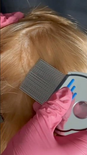 Extreme Itchy Scalp Scratching ASMR ✨ Brush & Comb Sounds for Instant Tingles (No talking)