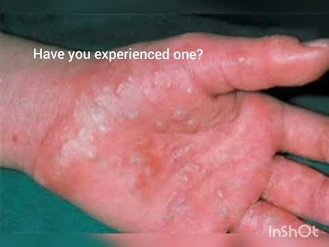What is dyshidrotic eczema?