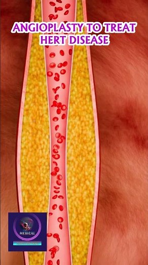 Angioplasty to Treat Heart Disease – Procedure, Benefits & Risks