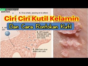 Ciri Ciri Kutil Kelamin Dan Cara Rontokan Kutil