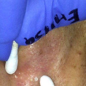 Enilsa Brown on Instagram: "Happy Saturday everyone! We are working on getting new content out for you all on YouTube and here on IG. We hope you enjoy this video. Be blessed. #pimple #pimplepopping #ance #pop #pimplesgalore #pimplepopper #pimpleproblems #pimples #enilsa #enilsaskinessentials"