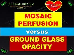Mosaic attenuation versus ground glass opacity for proper diagnosis of COVID 19 (Arabic)