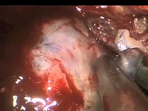 Middle Clinoid Bone Removal Using Endoscopic Method - Part 2 • Video • MEDtube.net