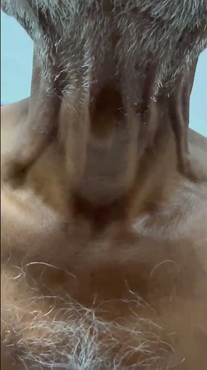 Corrigan's sign in a patient of Aortic Regurgitation