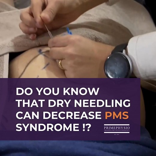 7.1K views · 21 reactions | Piriformis muscle syndrome (PMS) is a...