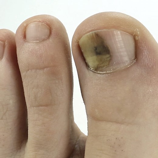 how to make toenail fungus go away - Toenail Fungus Treatment | Toenail Fungus Treatment