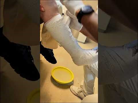How to Apply a Foot Cast for Fractures: Step-by-Step Guide for Perfect Healing