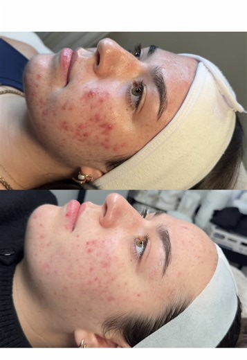 Incredible Acne Progress: Mairi's Journey After 6 Months