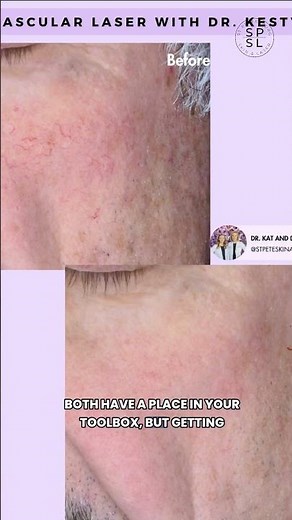 Lasers 101: How to Treat Redness #skincare #laser #dermatologist