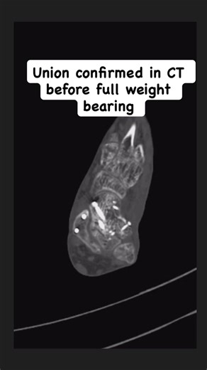6.8K views · 67 reactions | Crushed Impacted Talus fracture dislocation Hawkins IV injury referred to us after preliminary reduction but persistent subtalar and talonavicular subluxations. Major deformation of Talar undersurface contour. Did my best to ensure congruent ankle joint, some subtalar deformation persisted. Currently patient is asymptomatic and bearing full weight. | Just Ortho Things | Facebook