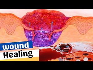 Skin Wound Healing Process #ulcers #ulcertreatment