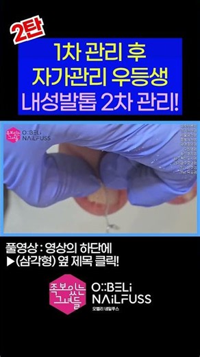 [2탄] 1차 관리 후 자가관리 우등생! 내성발톱 2차 관리 😎 #내성발톱 #toenails #ingrown_toenail #발톱무좀 #무좀 #무좀발톱 #족보있는그녀들