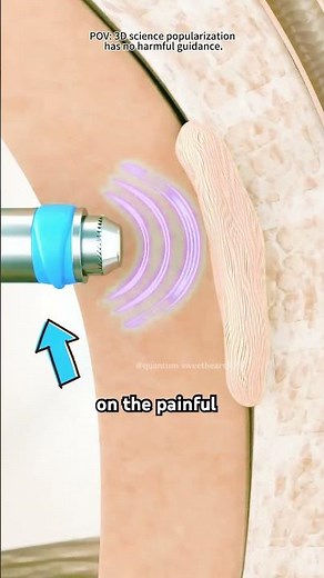 Shockwave Therapy (3D Animation)